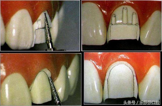 牙医曝光：烤瓷牙那点不为人知的事！