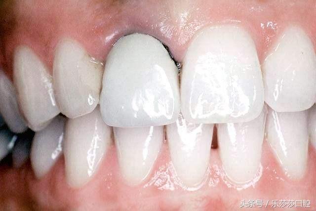 牙医曝光：烤瓷牙那点不为人知的事！