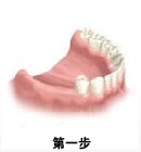 种植义齿修复包括哪几个步骤？