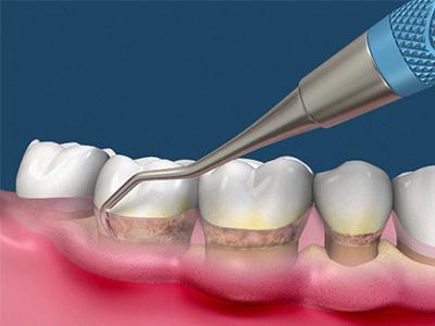 种植牙需要定期洗牙吗？
