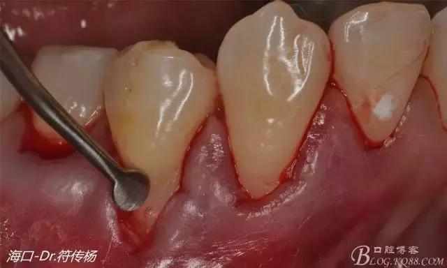 病例分享｜牙龈再生&根面覆盖术