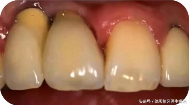 种植牙失败的原因都有哪些？