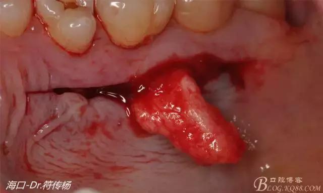 病例分享｜牙龈再生&根面覆盖术